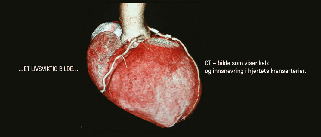 CT - bilde som viser kalk og innsnevringer i hjertets kransarterier.