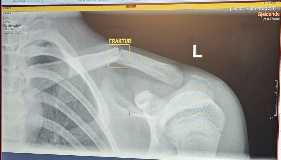 Røntgenbildet viser claviculafraktur, og dagens hovedperson i Ski må ta det rolig en stund fremover.